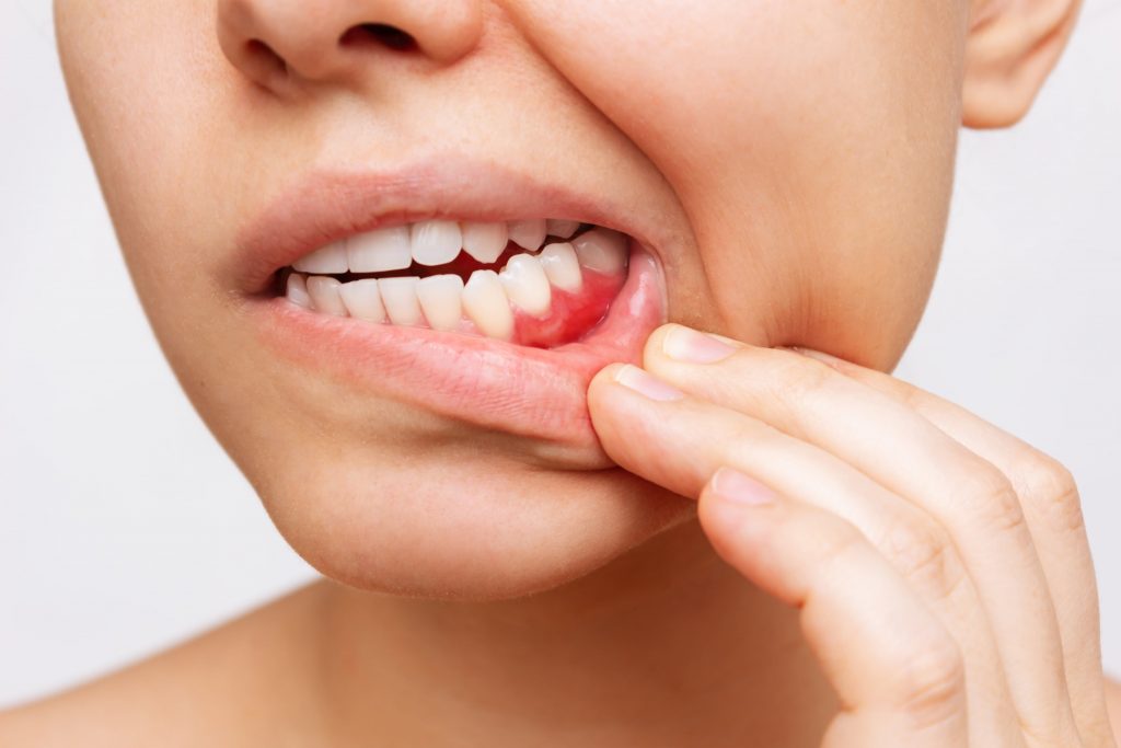 Everything You Need to Know About Periodontal Disease
